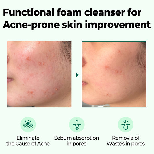 AHA-BHA-PHA Miracle Acne Clear Foam