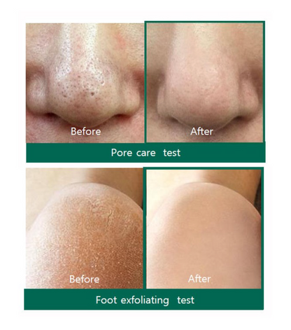 AHA-BHA-PHA Miracle Acne Cleansing Bar