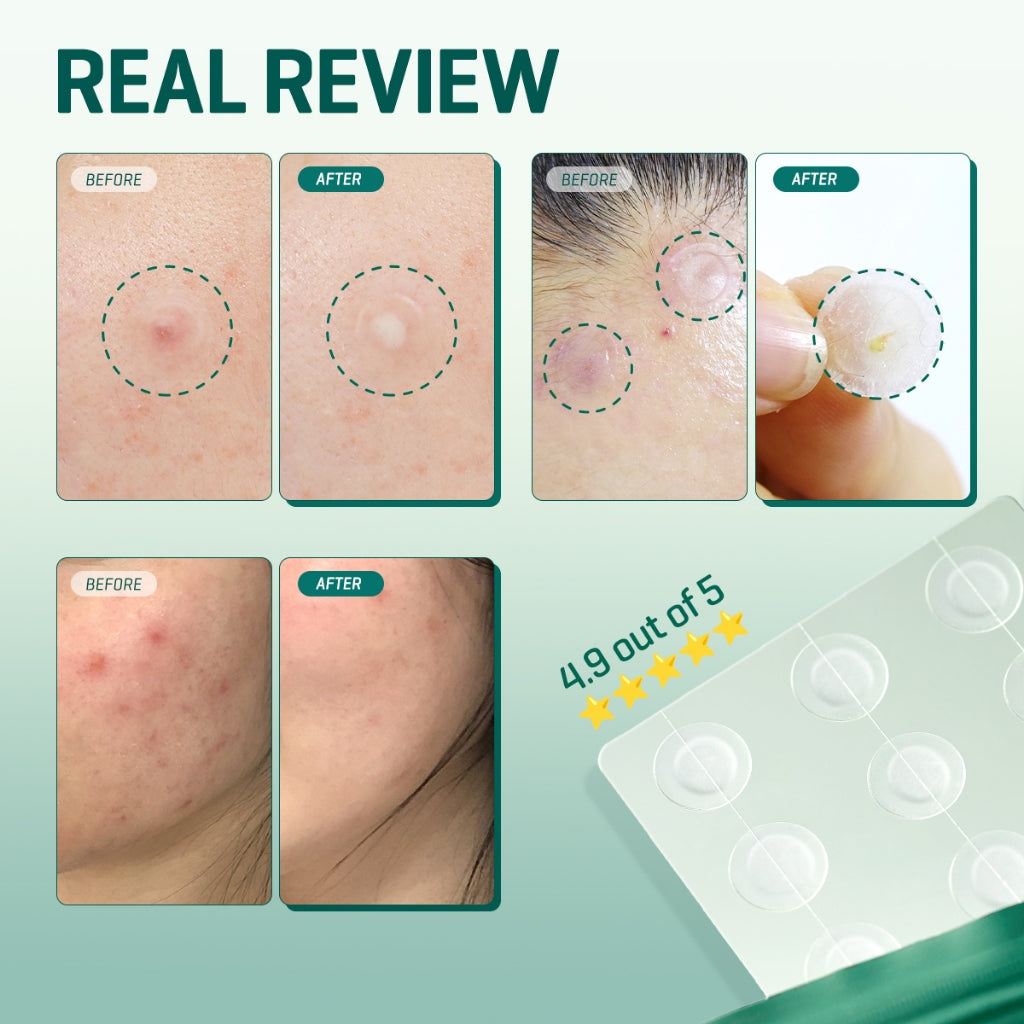 30 days Miracle Clear Spot Patches 18pcs